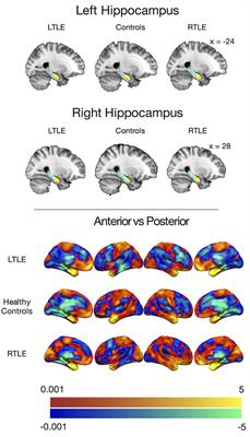 Parcellation of the Hippocampus Using Resting Functional Connectivity in Temporal Lobe Epilepsy